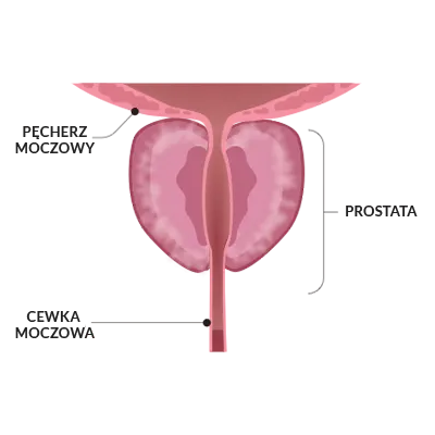 Rezum – system do leczenia BPH