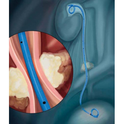 Stent moczowodowy Percuflex Plus z osłoną HydroPlus